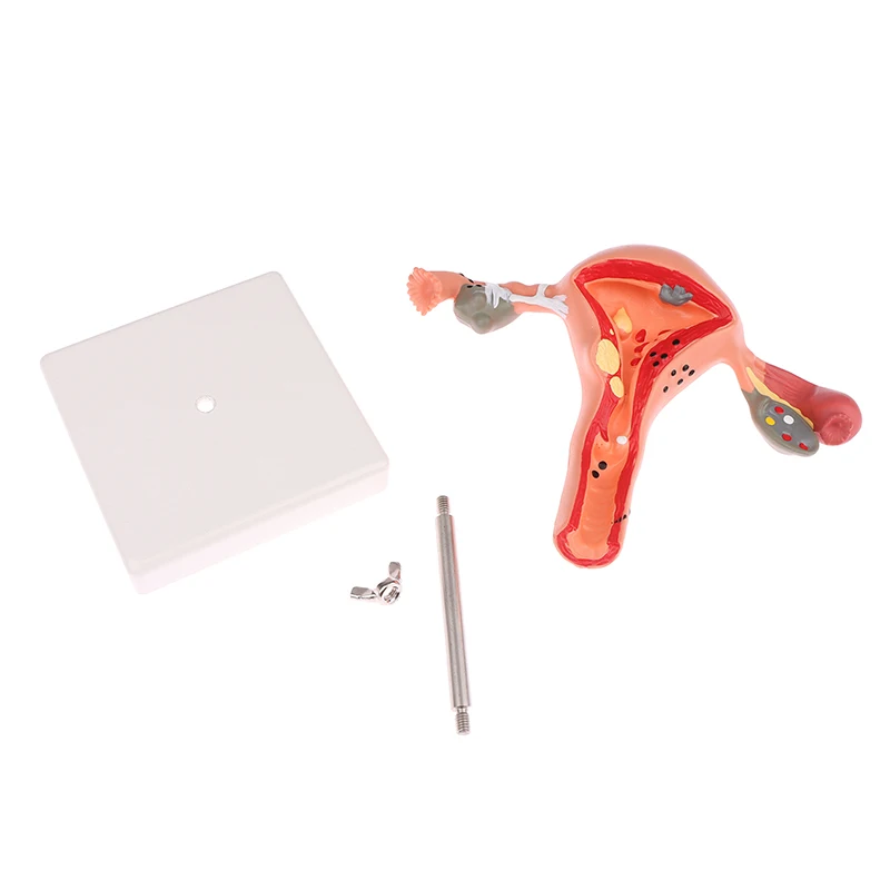 Human Pathological Uterus Ovary Model Cross Section Structure Model Uterus Anatomical Model Anatomy Female Organ Study Tool