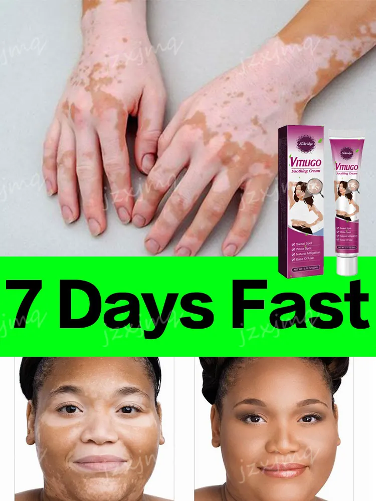 

Vitiligo Ointment Effectively Improvement Skin Eliminate White Spot