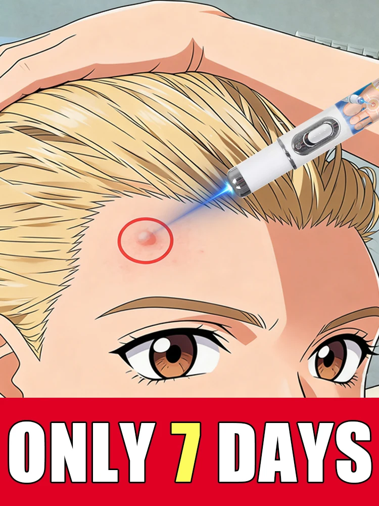 

Ручка-лазер второго поколения с синим светом: уменьшите свои заботы и перестаньте постоянно беспокоиться о бородавках.