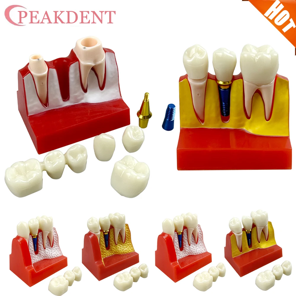 

Dental 4 Times Implant Teeth model Analysis Crown Bridge Demonstration Removable Model Dentisty Study Training Teaching Model