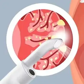 

Электрический визуальный инструмент для удаления камней из миндаля, набор для удаления камней, вакуум с ирригационным шприцом, мгновенное всасывание, удаление камней миндаля