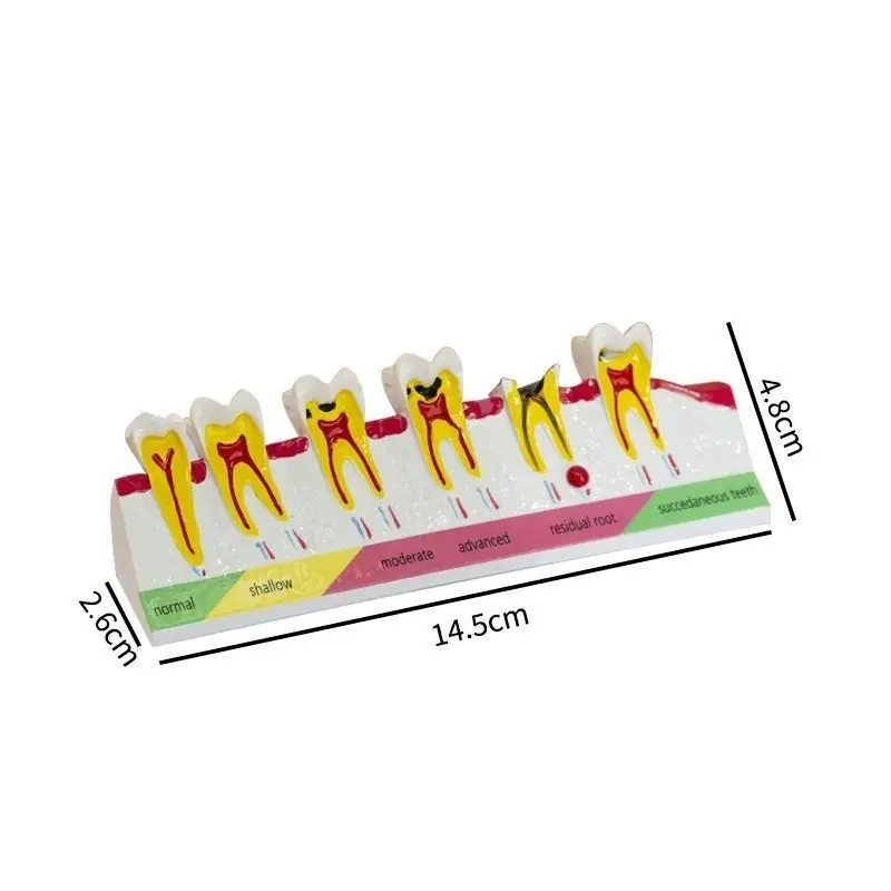 Lab Caries Classification Model 2 Times Tooth Model, Tooth Decay Bad Teeth Show Secondary Caries Shallow Deep Caries Mold s