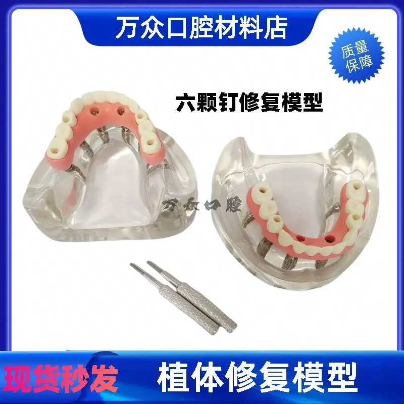 Dental Dental Model Ma Long Bridge Denture Restoration Implant Dental Simulation Demonstration Simulation Teaching Doctor-patien