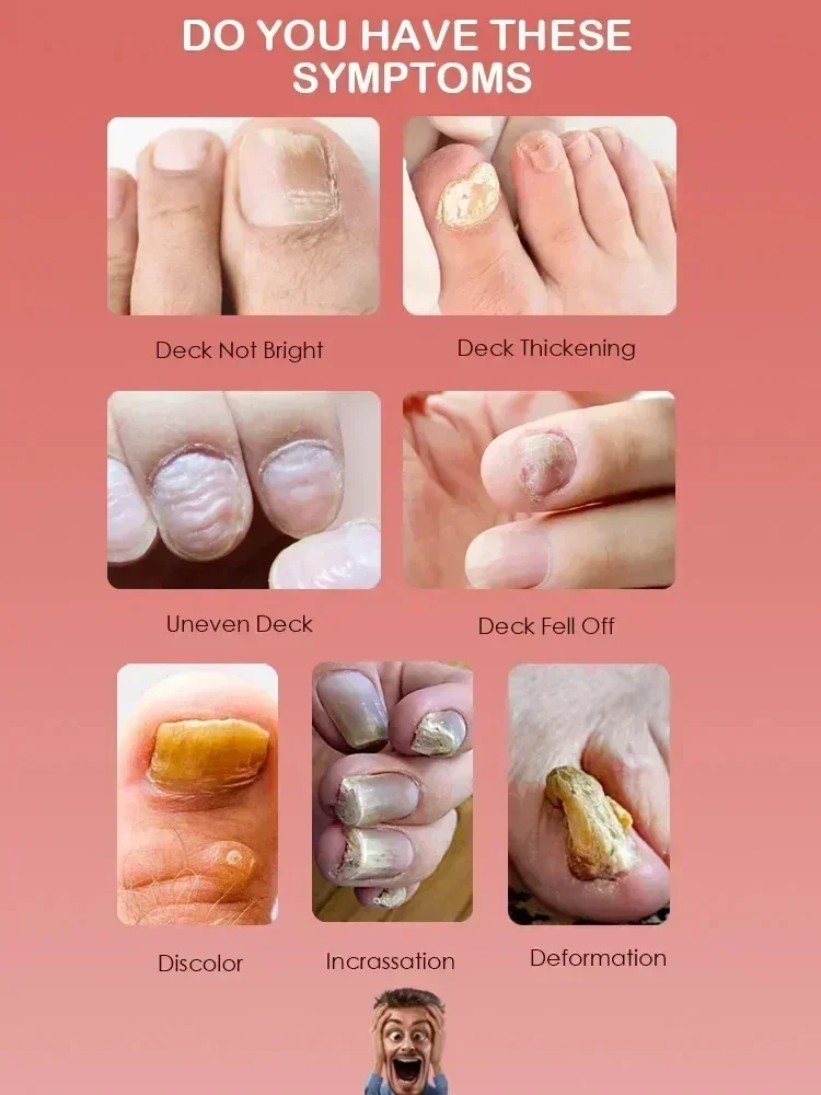 Tratamento de fungos nas unhas, essência para cuidados com os pés, clareamento dos pés, remoção de fungos nas unhas dos pés, gel anti-infecção, paroníquia, onicomicose