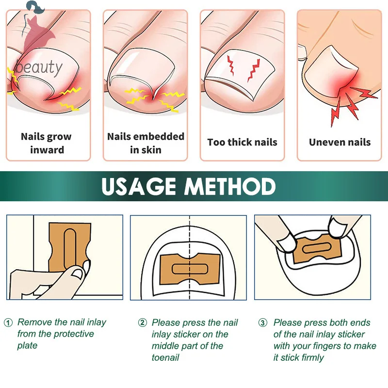 Autocollants pour soins des ongles incarnés, traitement de la paronyamitié, outil de pédicure, 50 pièces