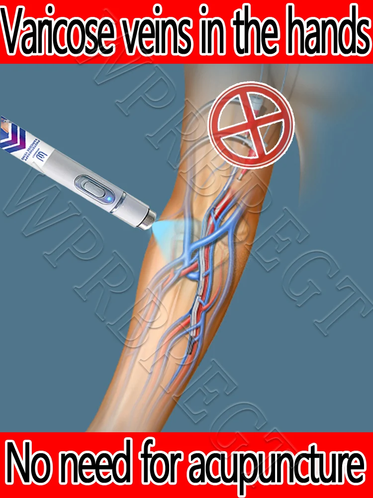 

2nd generation varicose vein laser eliminates vasculitis and phlebitis, relieves spider leg pain, laser pointer for treatment