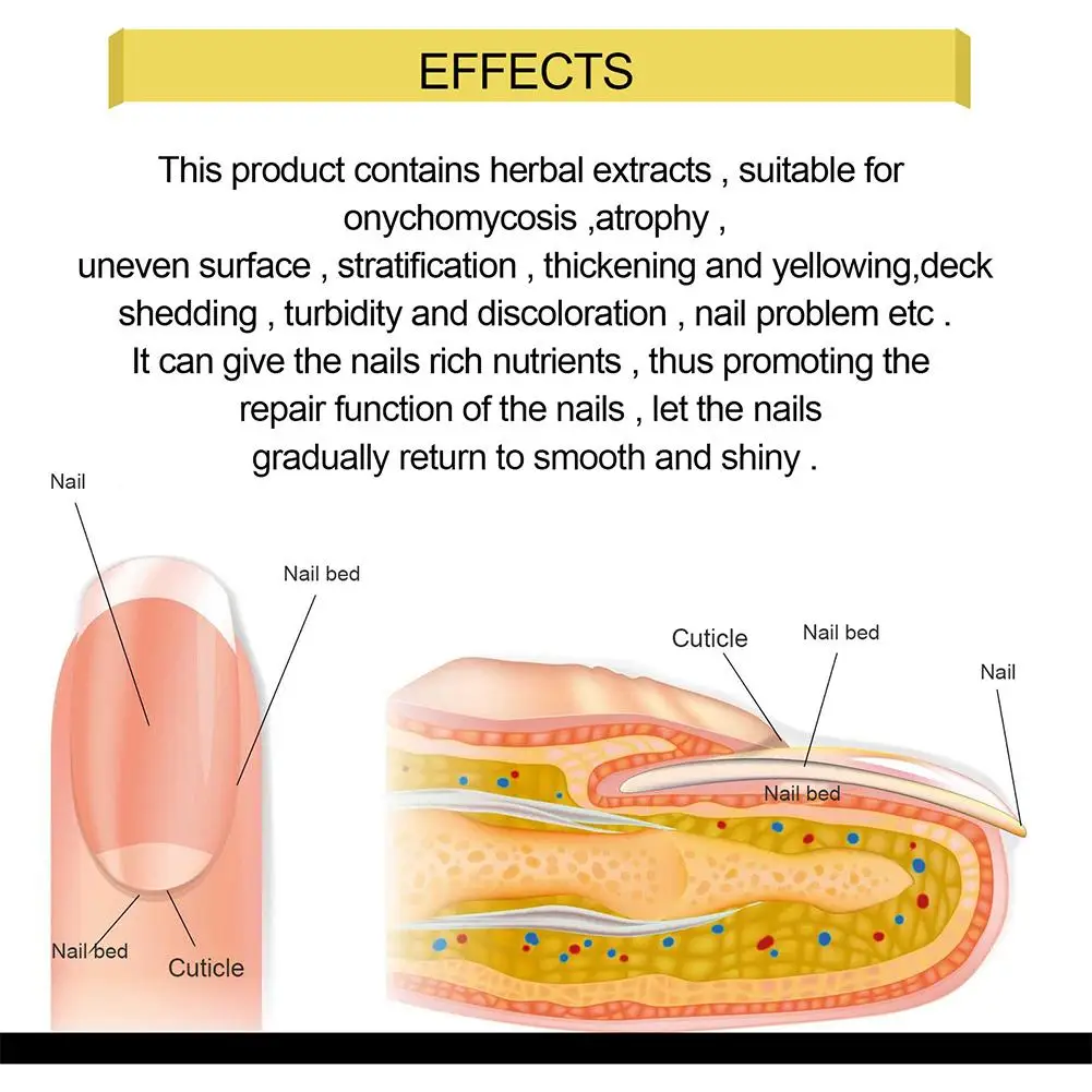 Nail Fungus Removal Cream Onychomycosis Fungal Nail Paronychia Ointment Care Infection Anti Feet Fungal Toe Nail J4D6 Treat E6Y8