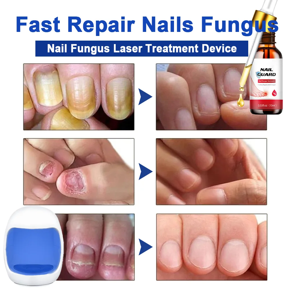 Fungal Nail Laser Device Repair Fast Nails Fungus Onychomycosis Repair Toenail Finger Nail Treat Removes Nail Fungus Foot Care