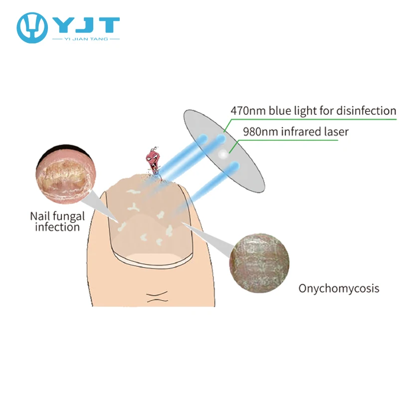 physical laser effective mini nail fungus onychomycosis physical laser therapy device