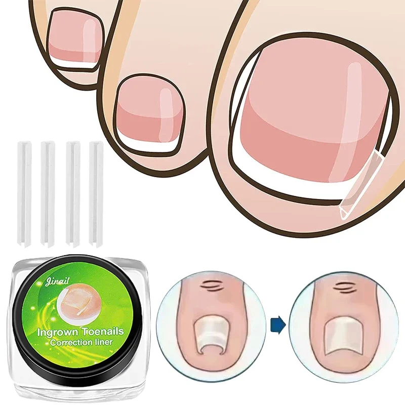 Nail Ingrown Corrector Nail Patch Correction Tube Pad Patch Corrector Nail Treatments Toenail Straightening Correctors Foot Care