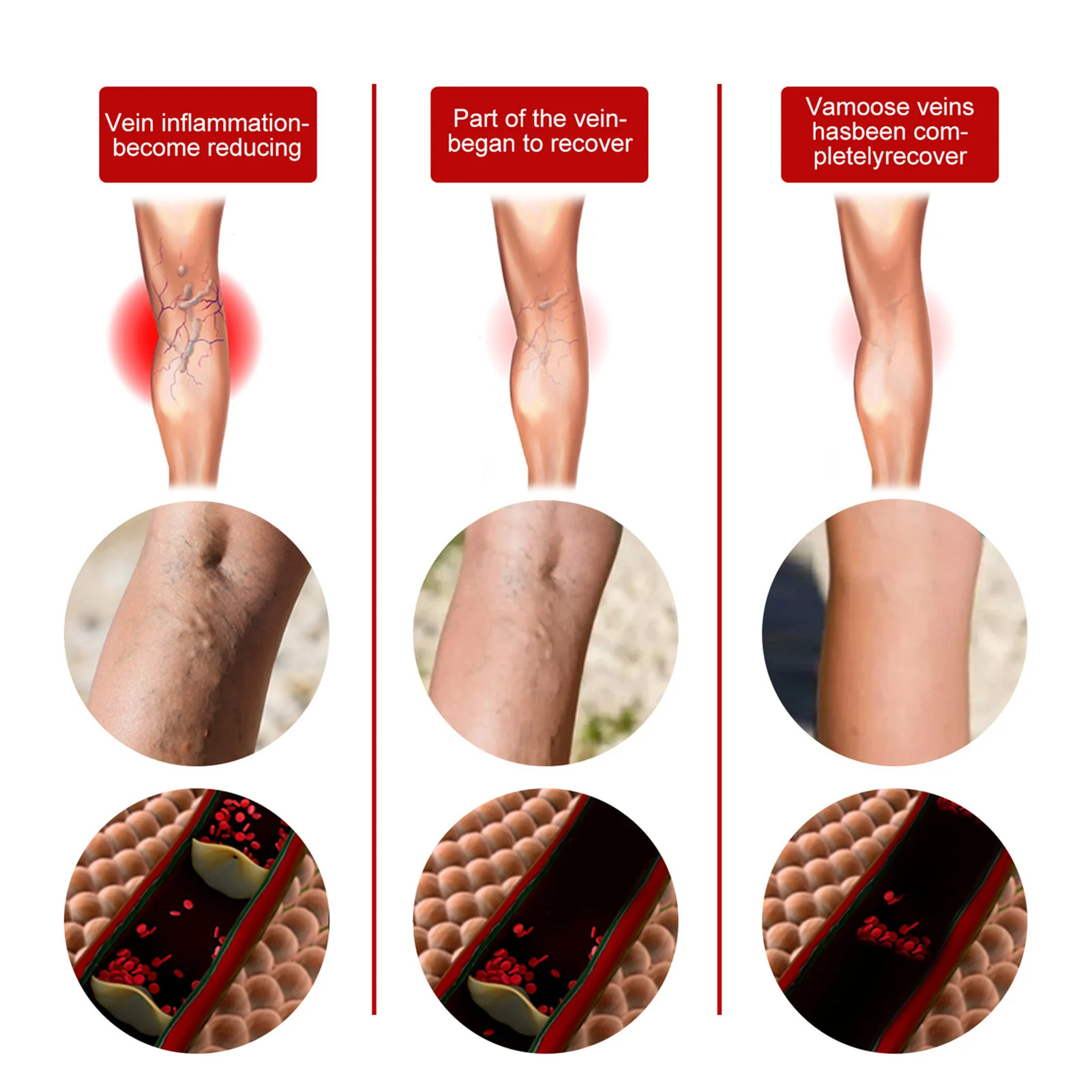 Parche para Vasculitis, reparación de angitis, Araña, gusano de tierra, piernas, desbloquea los vasos sanguíneos, tratamiento de venas varicosas, 12 piezas