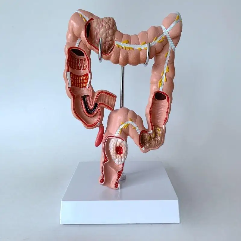 

Colonic lesion model Intestinal disease human colonic lesion model