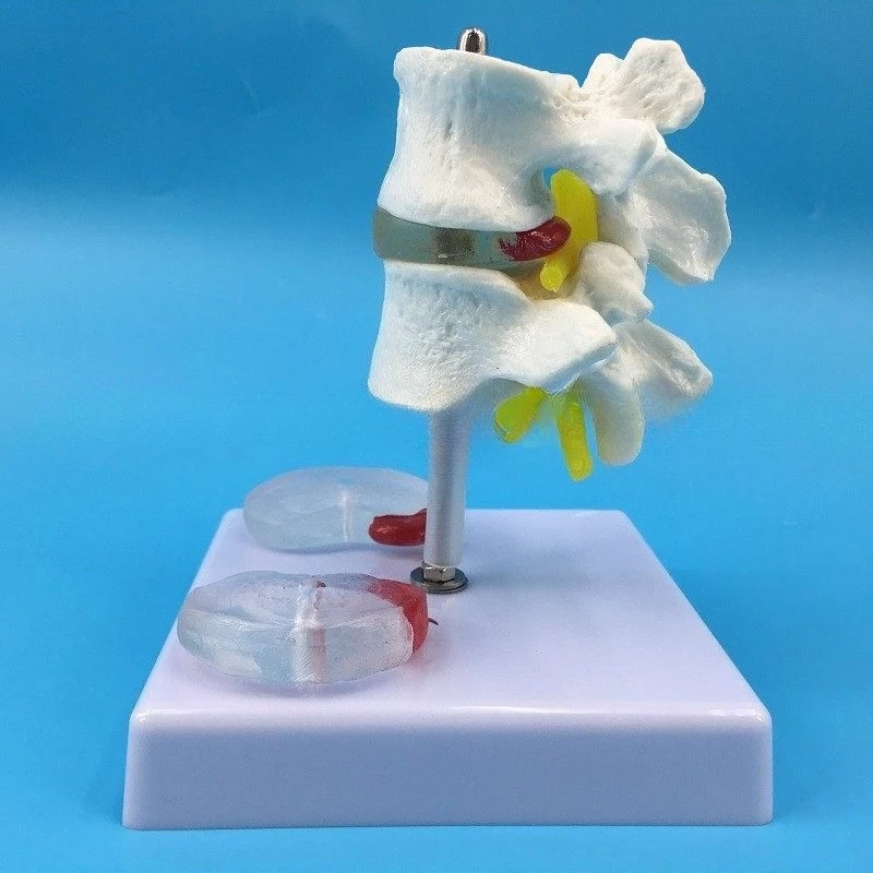 

Human lumbar spine model, two lumbar vertebral belt disease disc model, disc disease, spine bone demonstration