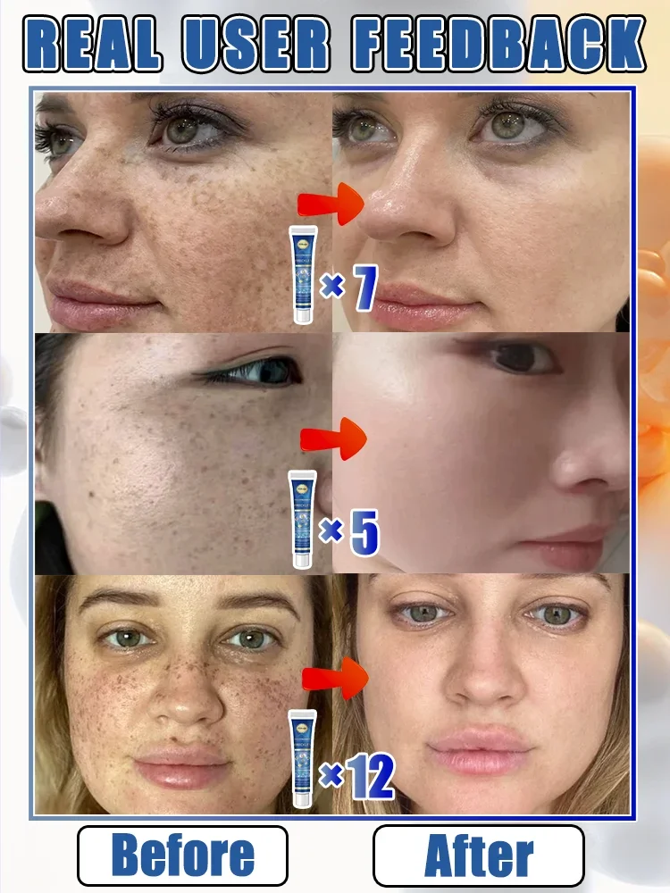 Laser Quick Repair of Facial Freckles