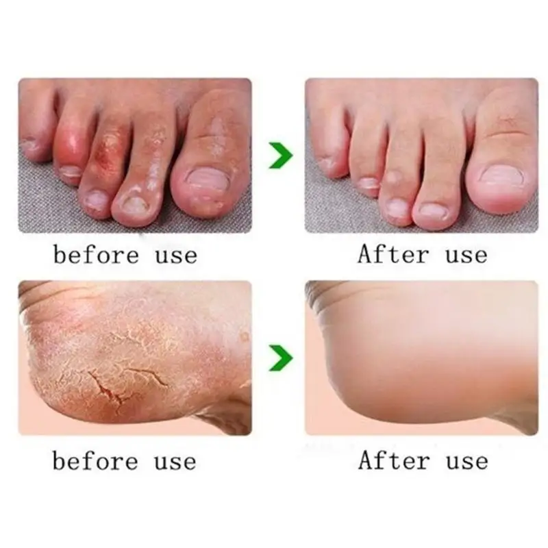 Horse Oil Hand and Foot Repair Cream Foot Cream Care Cream Beriberi and Itchy Feet Blisters Prevent Chapped