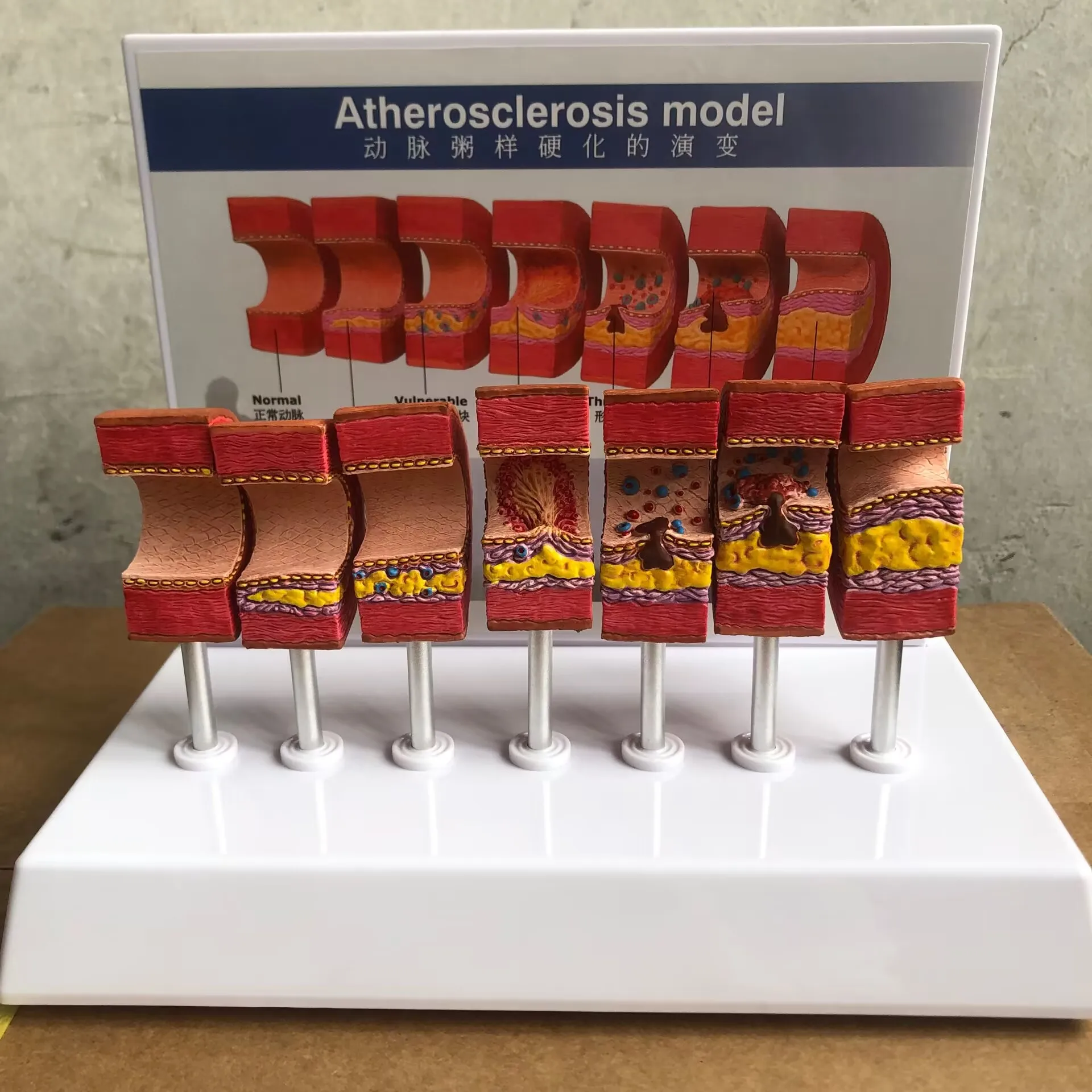 Atherosclerosis Model Vascular Thromboembolism Model Arterial Blood Vessel Human Medical Teaching Model