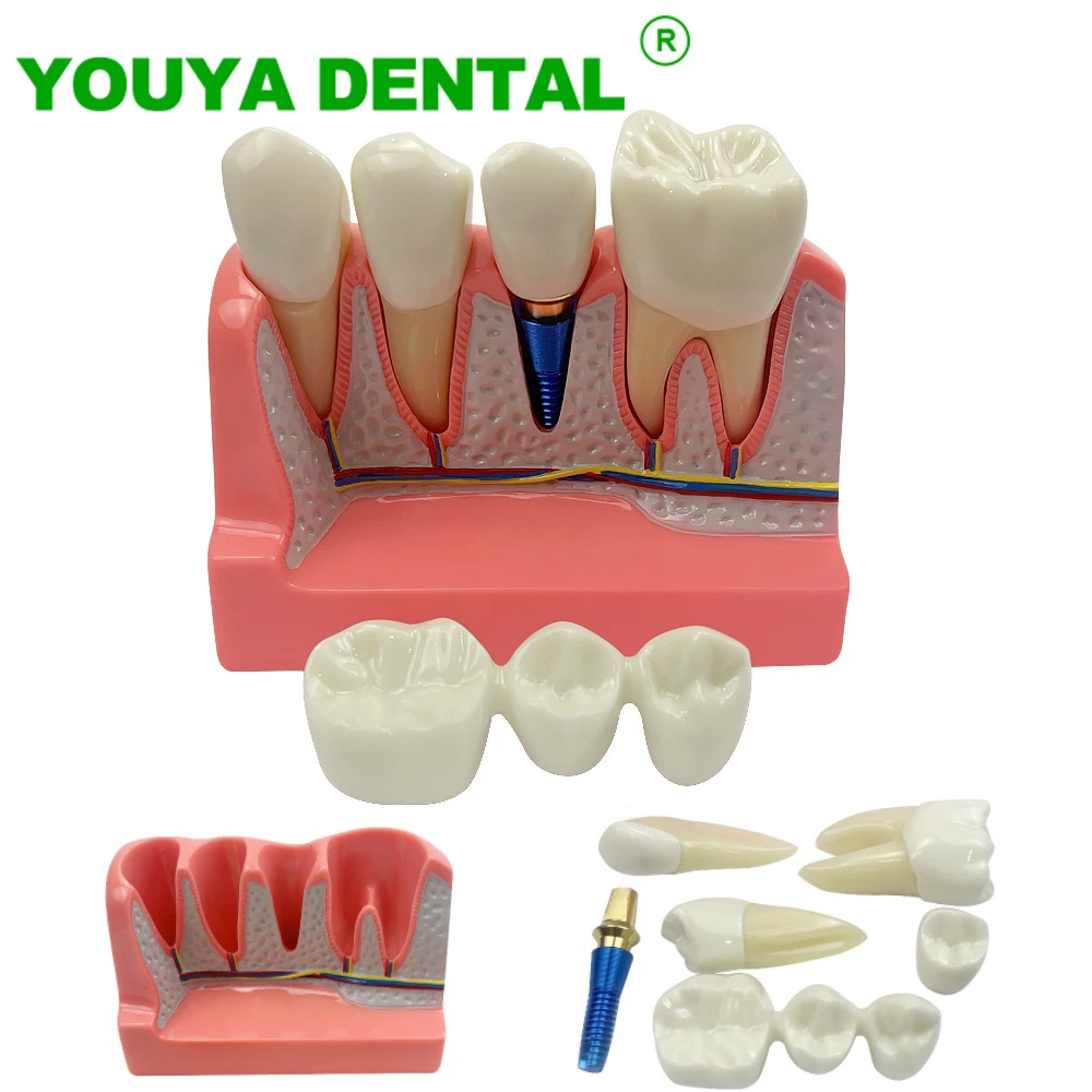 Dental Implant Model 4 Times Analysis Crown Bridge Removable Model Dentistry Demonstration Tools For Dentist Student Teach Study