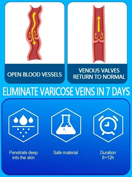 Varicose vein laser pointer | Improves Blood Circulation | Blue Light Laser