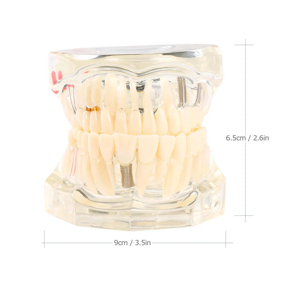 3Pcs Dental Implant Teeth Study Model Repairable Resin Model Of Diseased Teeth For Teach And Research In Medicine Dental Disease