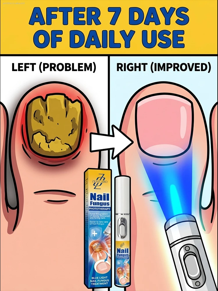 

Fungal Nail Laser Therapy Pen, Professional Home Care Tool