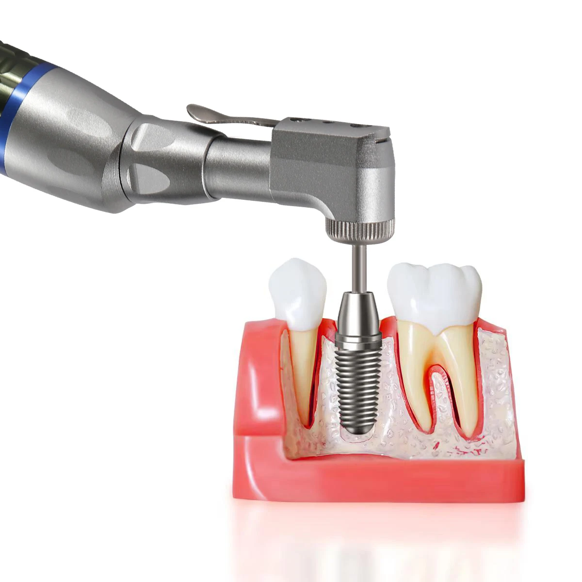 

Регулируемый наконечник для зубного имплантата, универсальный набор протезов, динамометрический ключ, съемник отверток