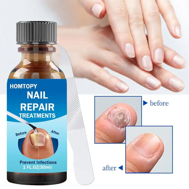 Nail Repair Solution para Danificado e Pé, Fortalecedor, Unhas rachadas e unhas dos pés, Mão e Pé, Care Treat