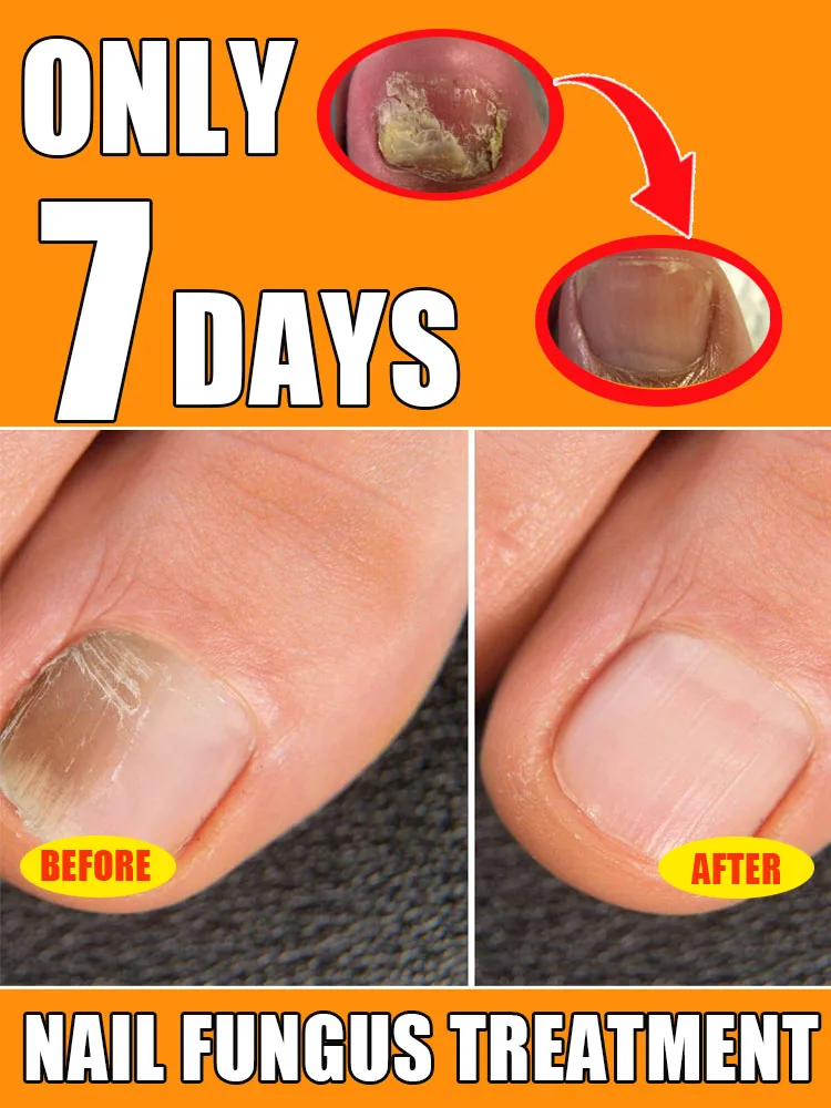 ᴺᵃⁱˡ ᶠᵘⁿᵍᵘˢ ᵗʳᵉᵃᵗᵐᵉⁿᵗ ᵉˢˢᵉⁿᵗⁱᵃˡ ᵒⁱˡ⸴ ʳᵉᵖᵃⁱʳ ᵒⁿʸᶜʰᵒᵐʸᶜᵒˢⁱˢ ⁱⁿ ⁷ ᵈᵃʸˢ