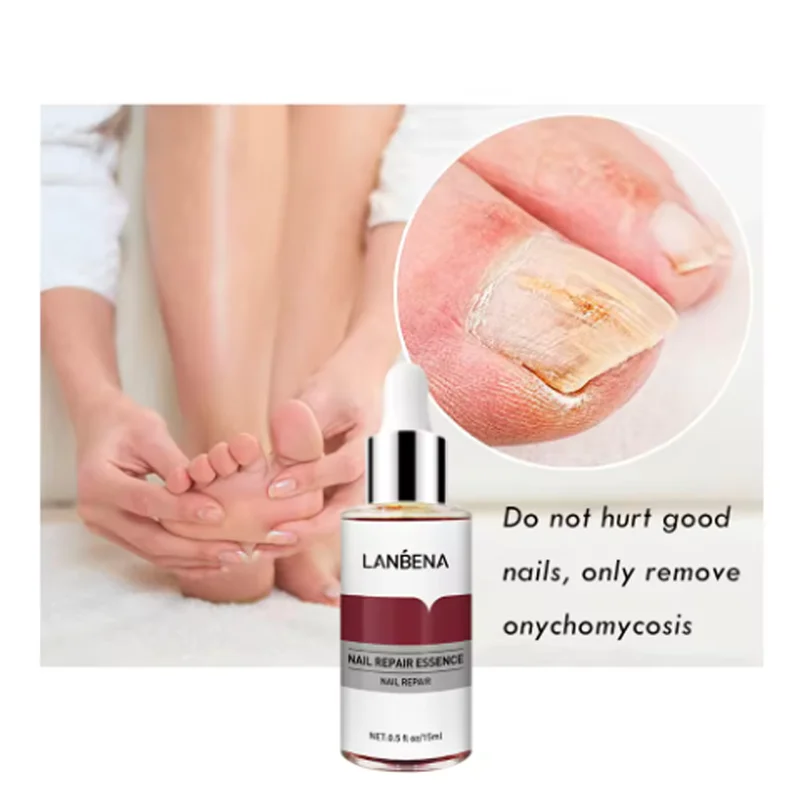 LANBENA cura dei funghi rimuovi onicomicosi dita dei piedi nutrire illuminare le mani piedi riparazione del prodotto adatto donne Pepair per unghie Essencs