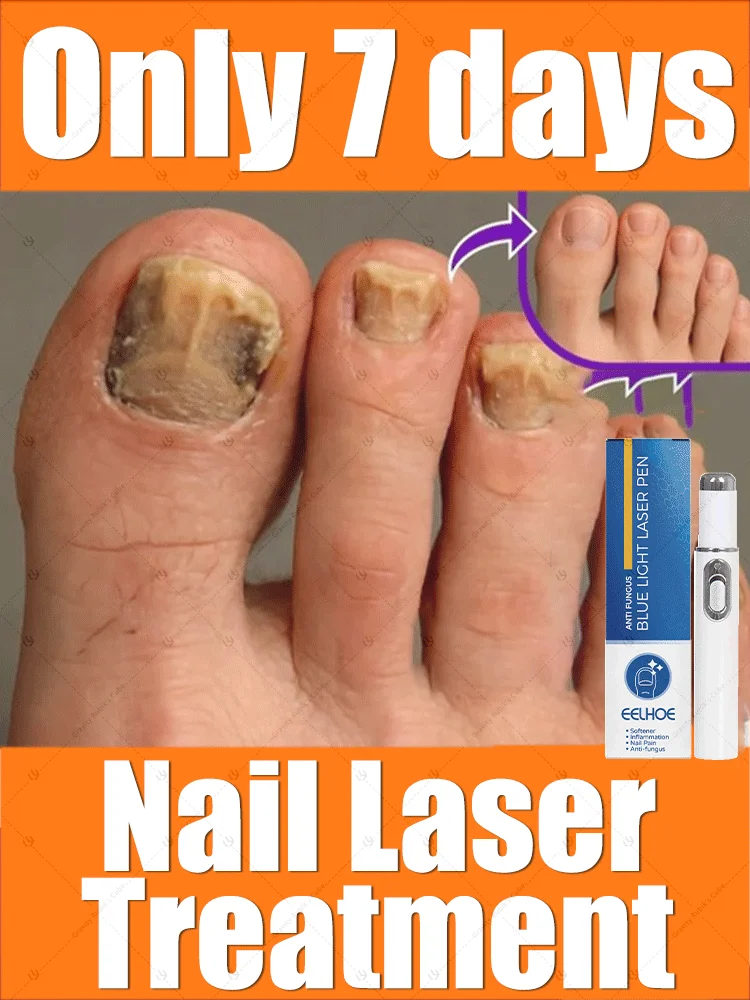 

Say goodbye to onychomycosis, no recurrence, no damage to nails.