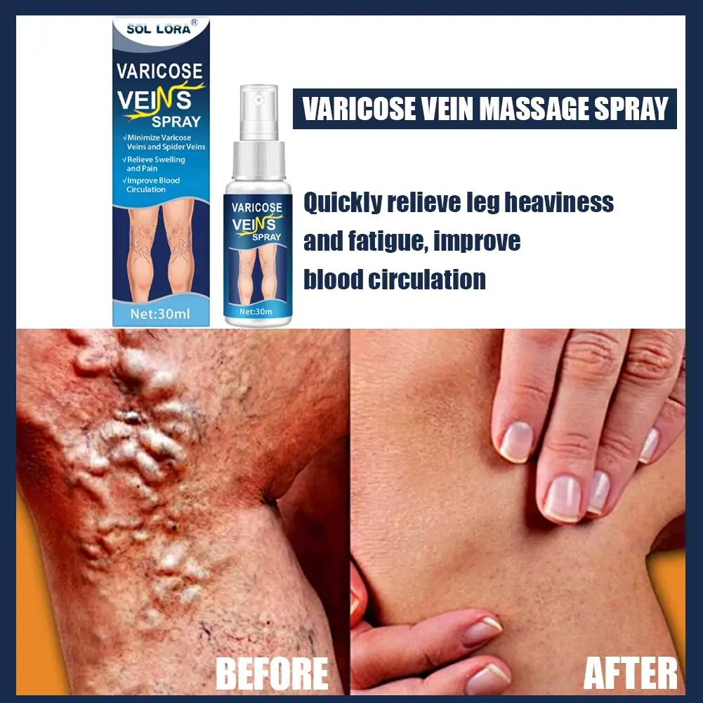 

30ml Varicose Vein Spray Natural Herb Veins Soothing Blood Relieves Leg Discomfort of Family Size The Spray Circulation Pro U1G9