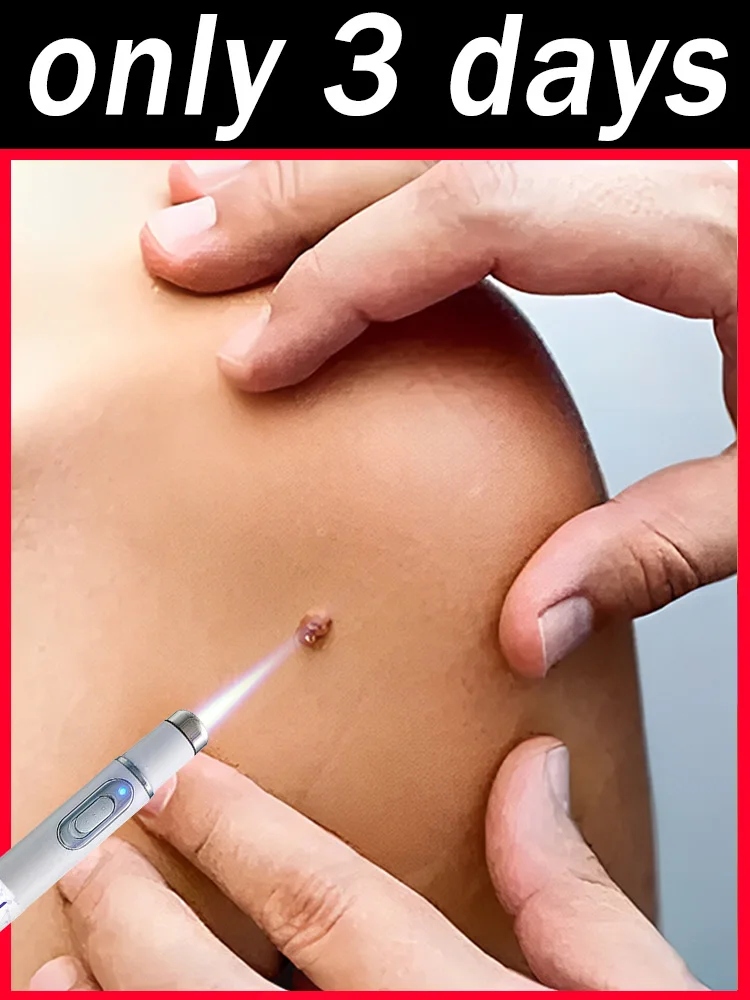 

Первое поколение, обновленное средство для удаления бородавок, быстро устраняет бородавки и остроконечные кондиломы.