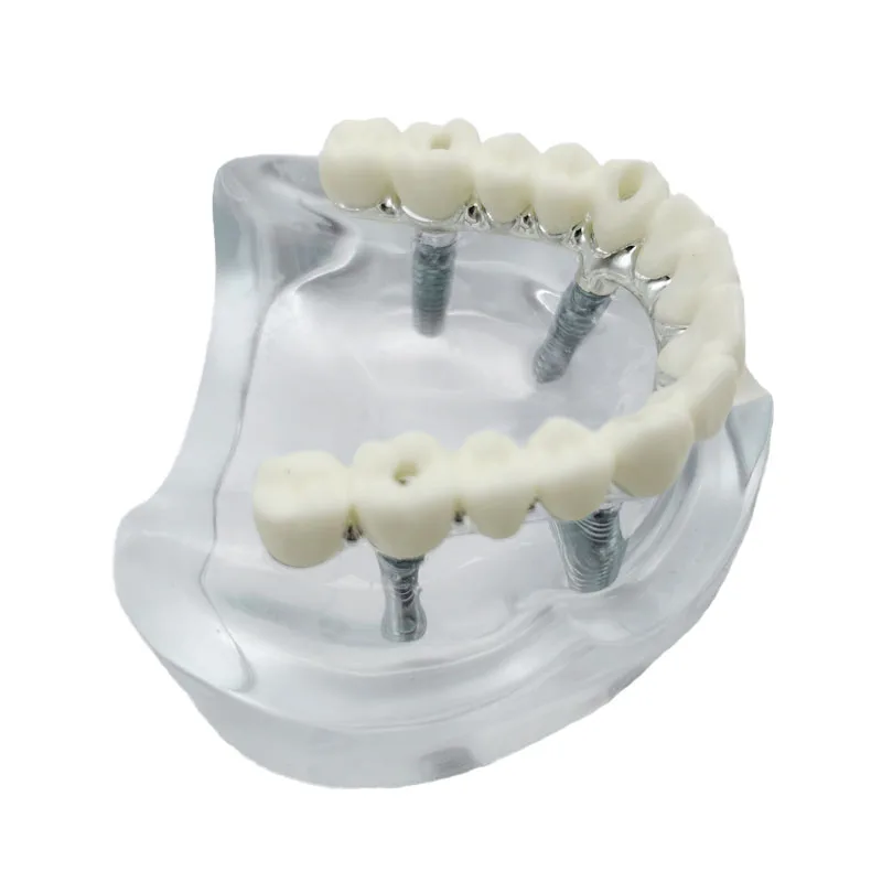 Dental Model Implant Restoration Model Maxillary Removable Overdenture Model With 4 Implants Dentist Students Education Model