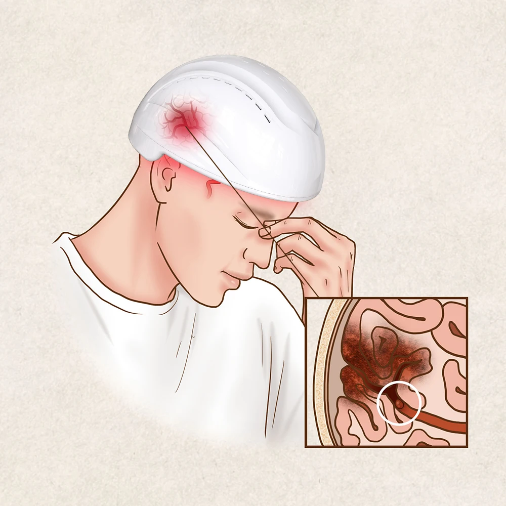 물리 치료 PDT 치료 항우울증 치료 장치, 뇌 신경 자극기