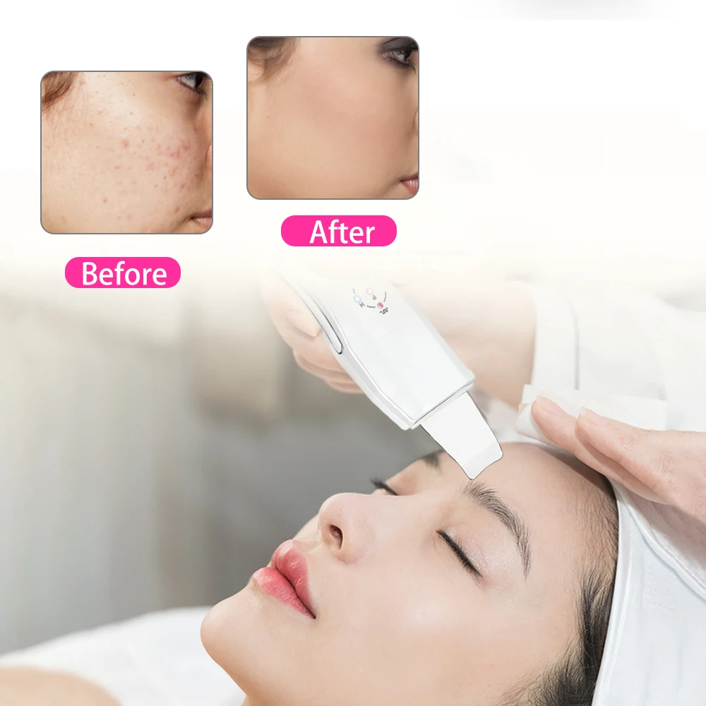 Ultrasonic Skin Scrubber, Facial Spa Massageador, Face Cleaner, Peeling Anion, Limpeza de Poros, Novo