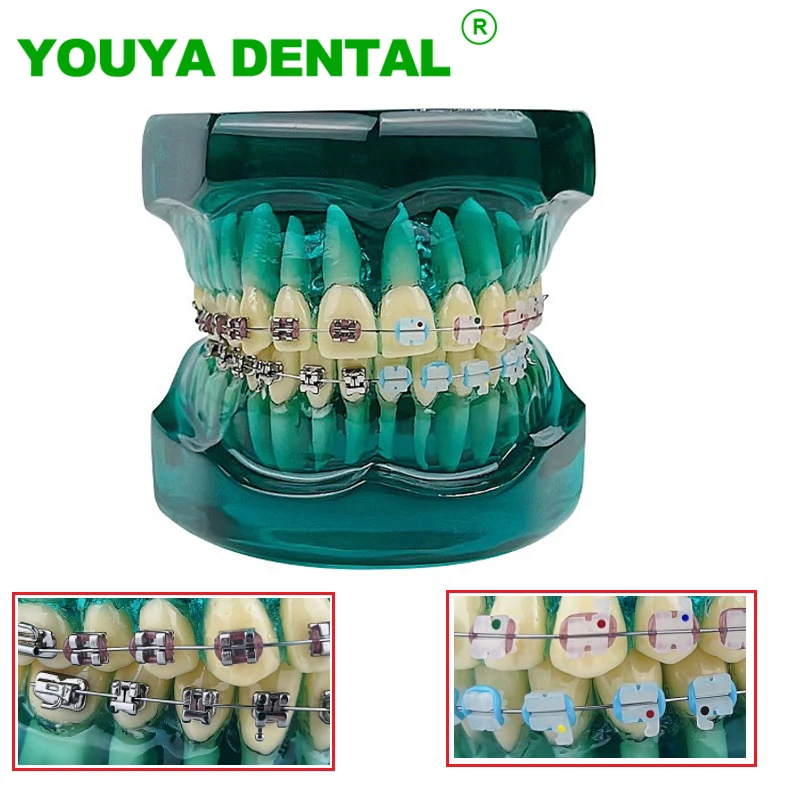 Orthodontic Model Self Ligating Metal Brackets Model Dental  Treatment Teeth Model With Ceramic Braces Arch Wire Ligature Ties