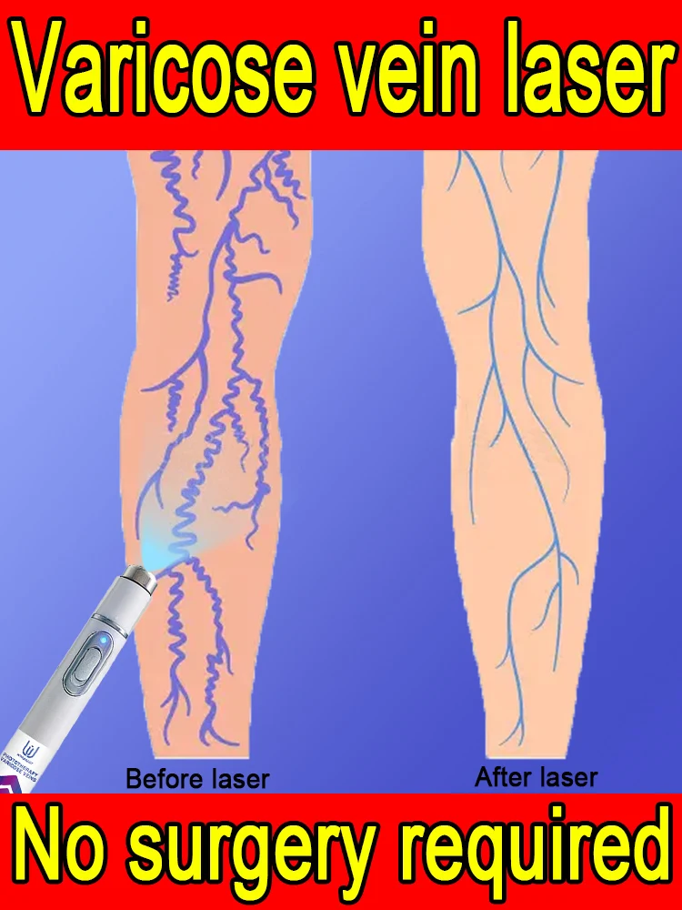 

Лазерная указка для варикозного расширения вен