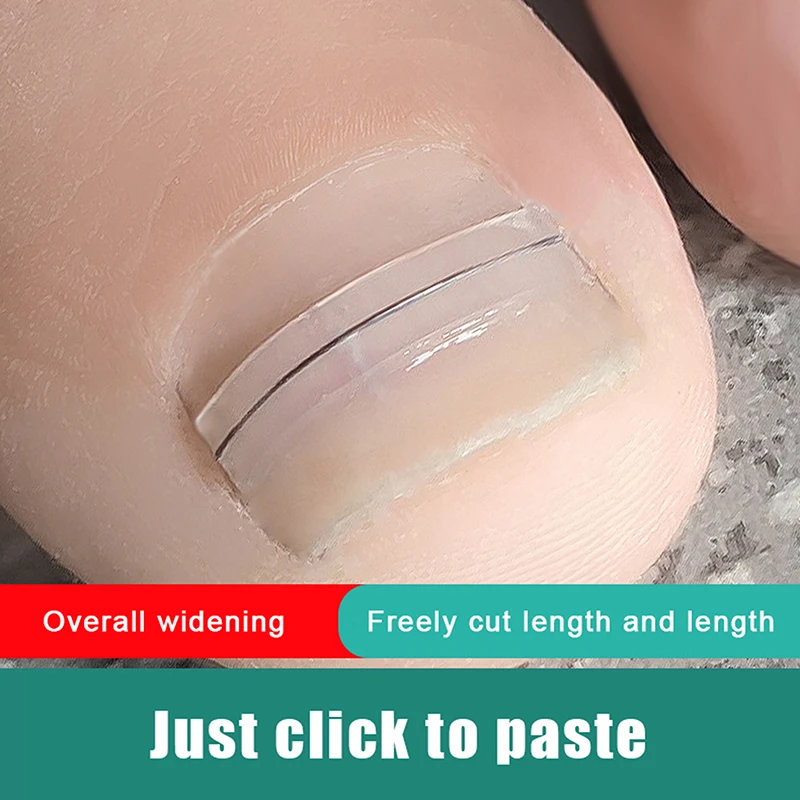 Ingrown Toenail Correction Tool Ingrown Toe Nail Treatment Elastic Patch Sticker Straightening Clip Brace Pedicure Tool