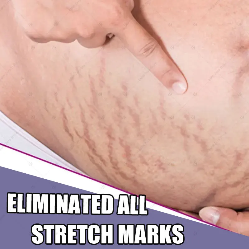 

Крем для перманентного удаления растяжек