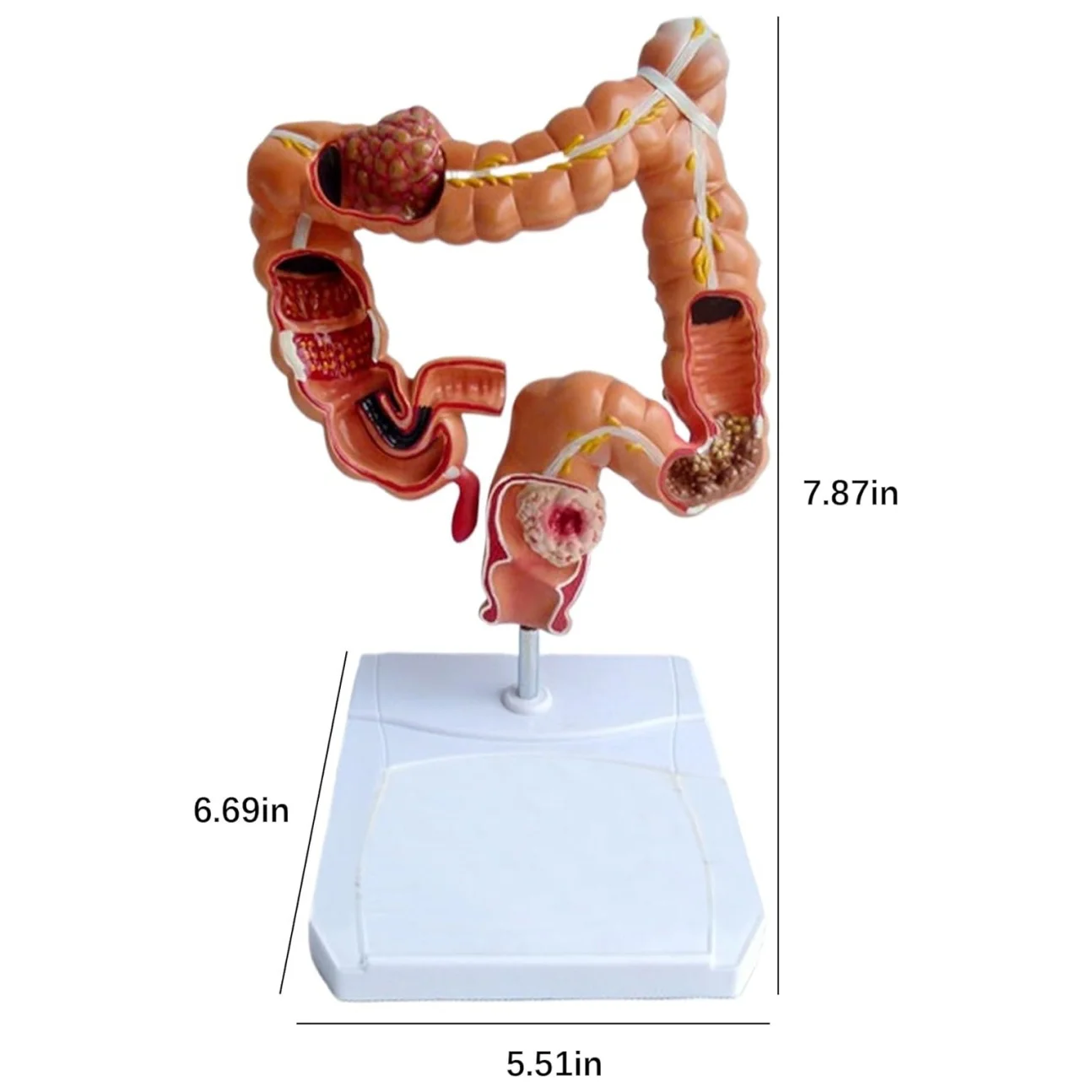 1:1 Life-Size Human Body Colon Pathology Model Digestive System Large Intestine Anatomical Study Model Physiology Study Tools