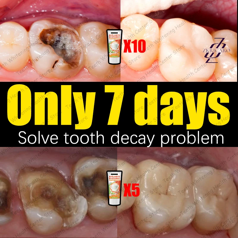 Cavity Repair Teeth Cleaning