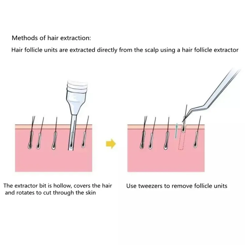 FUE Punch Hair Transplant Implanter 0.8 MM 0.9MM 1.0MM for hair follicle extraction machine