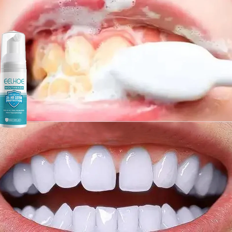 

2023 New Tooth Stain Removal Gum Bleeding Whitening Deep Cleaning Dental Plaque Oral Hygiene Products