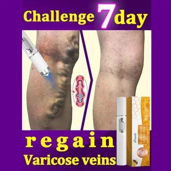 Terapia abażurowa na żylaki Skuteczna ulga rozszerzonego zapalenia naczyń w nogach Zapalenie żył Ulepszona krążenie krwi