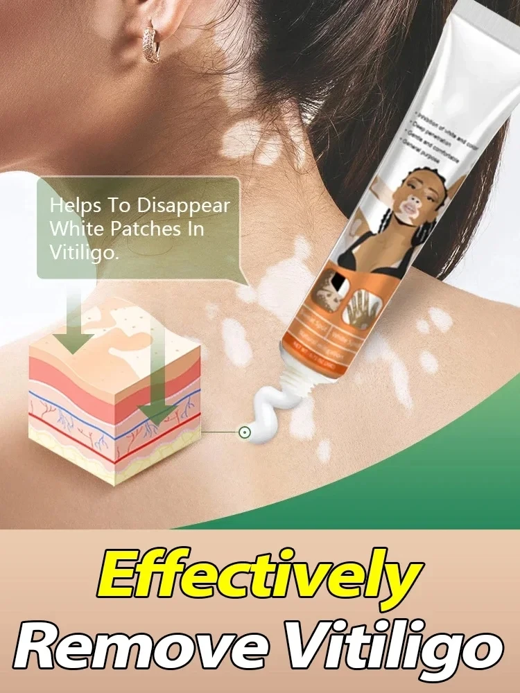 

Effectively Remove Vitiligo Ointment Ringworm White Spot Removal Skin Vitiligo Eliminate Vitiligo Skin Care