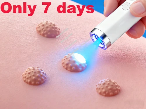Verrugas mejoradas de segunda generación reparación de raíz de verrugas uickly 8