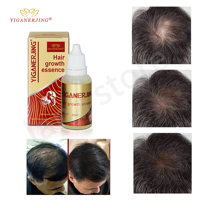 

5PCS YIGANERJING Treatment for hair loss Hair Growth Products Essence Hair Liquid damage hair repair treatment Dense Hair