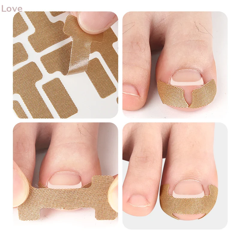 5 hojas de parche para tratamiento de uñas, antiinfección, paroniquia, onicomicosis, uñas encarnadas, ranura, corrección de hongos, pegatina de reparación