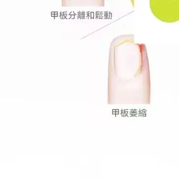 

HLKGO Portable Nail Fungus Treatment Device - 470nm and 905nm Laser for Toenail and Fingernail Fungus Removal