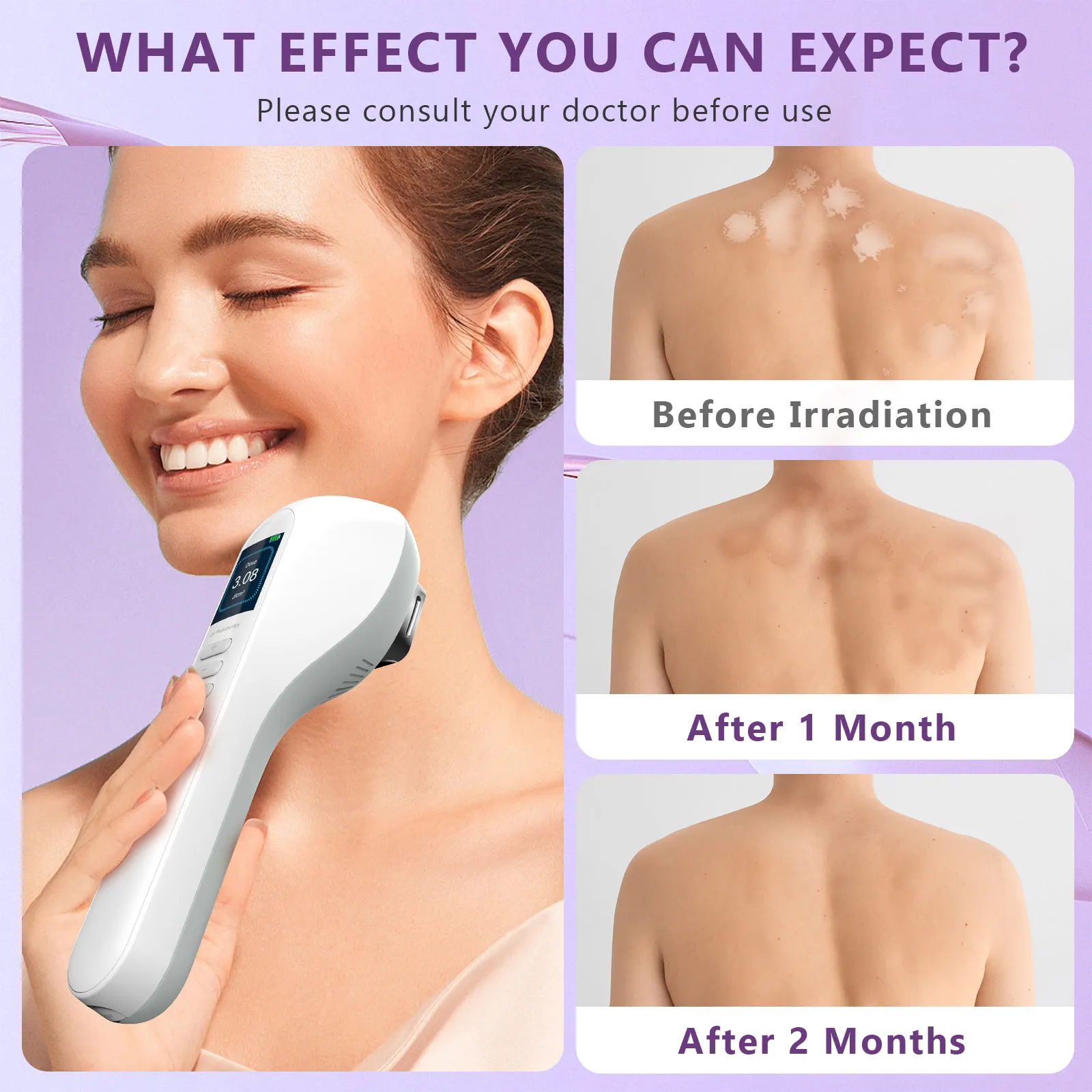 KTS UVB جهاز مصباح العلاج بالضوء لعلاج البهاق 308NM UV ضيق النطاق الأشعة فوق البنفسجية العلاج بالضوء الصدفية البقع الأكزيما #4
