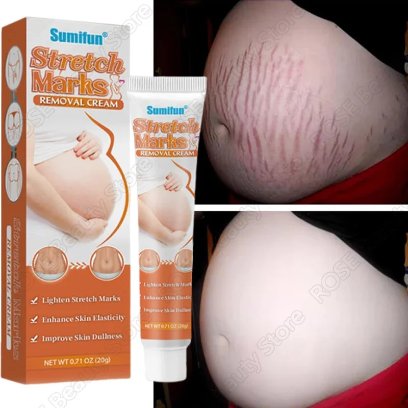 

Remove Stretch Marks Cream Anti Wrinkle Anti Aging Maternity Skin Repair Remove Pregnancy Scars Treatment Body Firm Skin Care